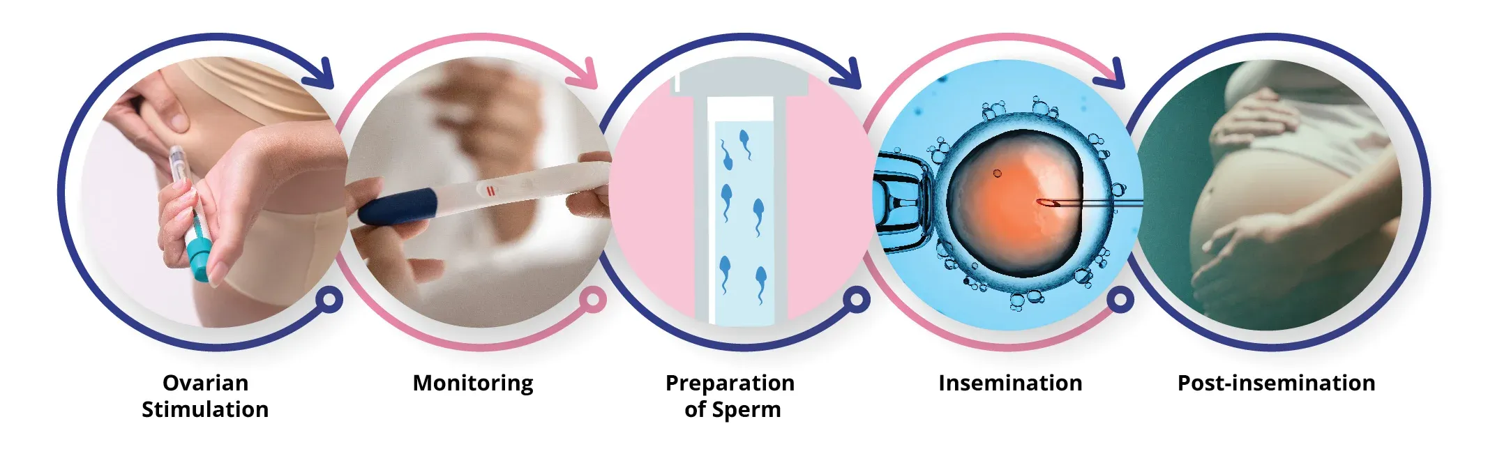 IUI Treatment | Intrauterine Insemination at Future Fertility